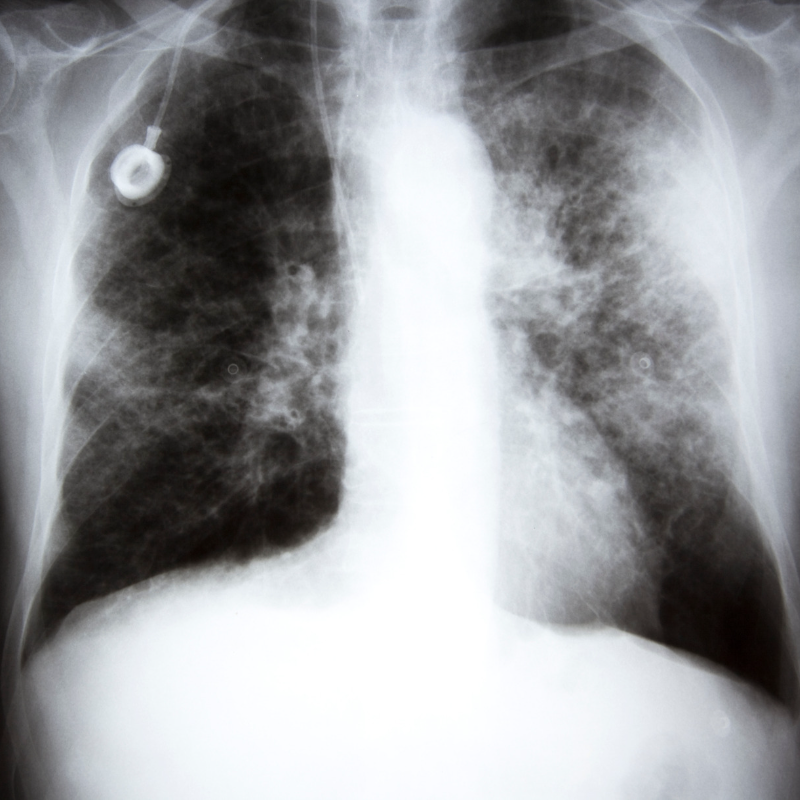 5 Causes Of Lung Cancer That You Should Be Aware Of